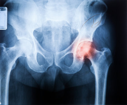 X ray MRI - Image of Spine pain and Hip bone..