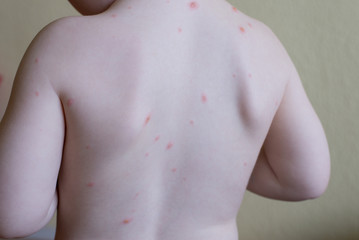 Chickenpox disease