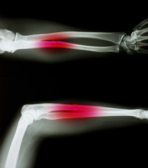 X-ray of both human arms.