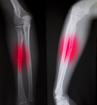 X-ray of both human arms (broken arm)