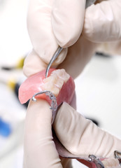 Proteza zębowa częściowa na łuku akrylowym