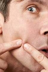 Men squeezing a pimple