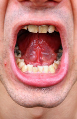 Tartar and tooth decay