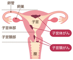 Fototapeta premium 子宮がん 女性のからだ