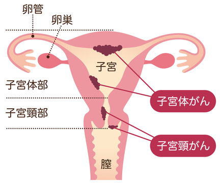 子宮がん　女性のからだ