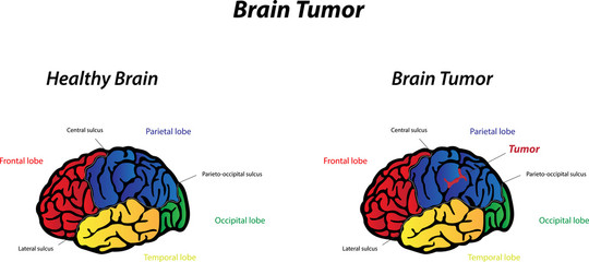 Brain Tumor