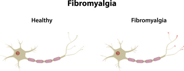 Fibromyalgia