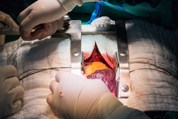surgeon apply sternum retractor