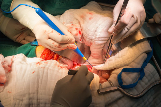 explore laparotomy