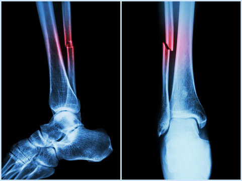 Fracture shaft of fibula bone ( leg bone ) .  X-ray of leg
