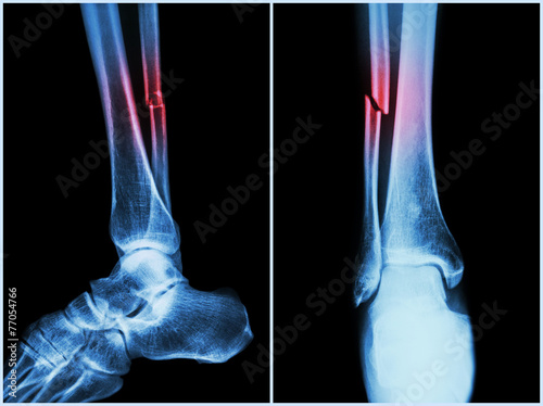 "Fracture shaft of fibula bone ( leg bone ) . X-ray of leg" Stockfotos