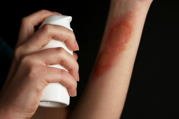 Treatment of burns by spray on female hand on black background