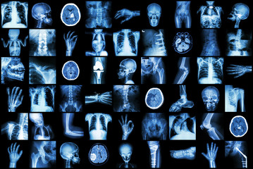 X-ray multiple part of adult and child and Disease