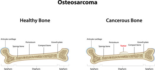 Osteosarcoma
