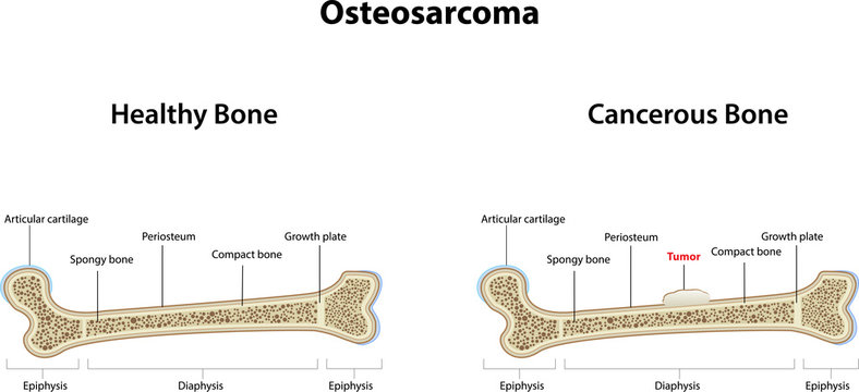 Osteosarcoma