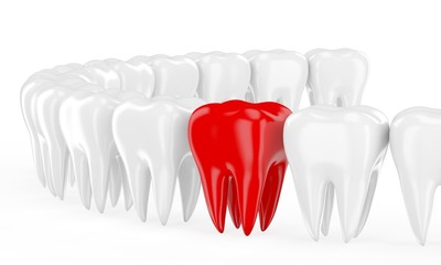 Aching tooth in row of healthy teeth. 3d