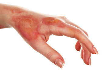 Horrible burns on female hand isolated on white - 77427144