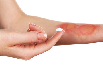 Treatment of burns on female hand, isolated on white