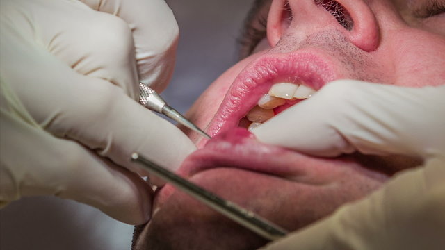 Dentist starts to drill on dental patient's upper teeth