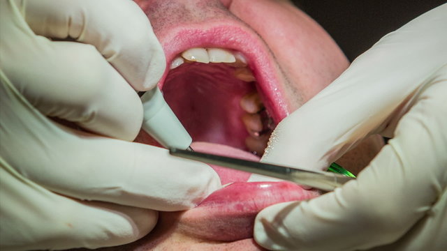 Dentist is mending patient's teeth using tools and mirror 