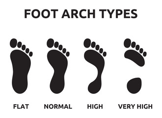 Foot arch types - 77606924