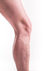 Varicose Veins on the legs of woman