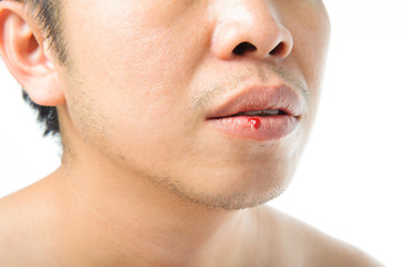 Mouth injury bleeding