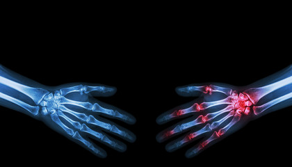 X-ray normal person is shaking hand with Arthritis hand person