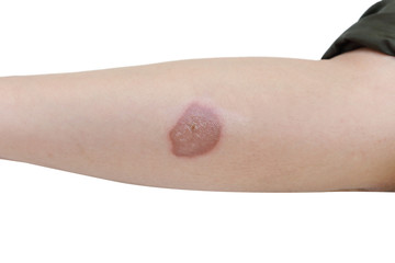 scald burn blister on forearm