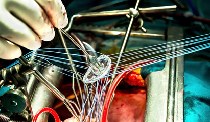 Close-up view on mitral ring durring inplantation