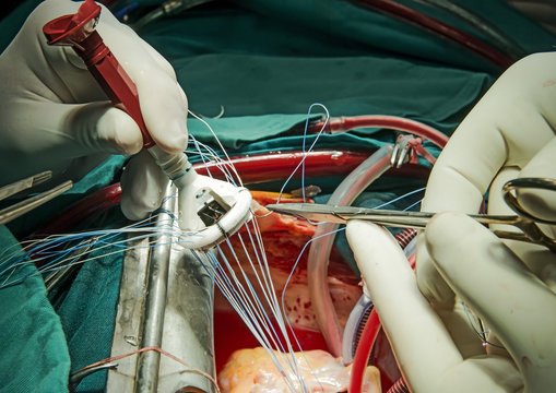 Mechanical heart valve implantation
