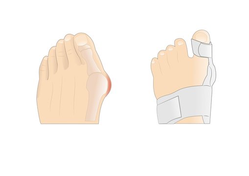 alluce valgo e correzione con tutore