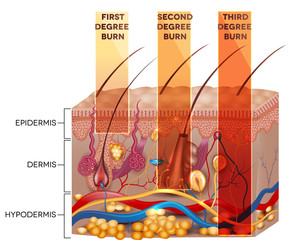 Skin burn classification. First, second and third degree skin bu - obrazy, fototapety, plakaty