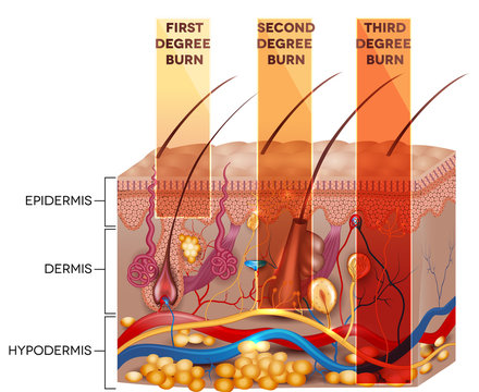 Skin burn classification. First, second and third degree skin bu