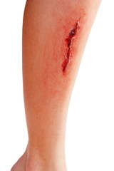 Fototapeta premium Injured leg with blood isolated on white