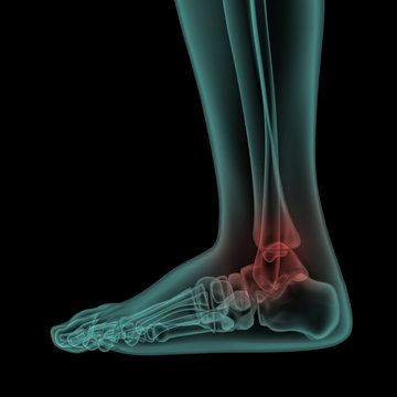 side x-ray view of human painful foot and ankle