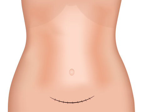 Supra Pubic Incision Scar