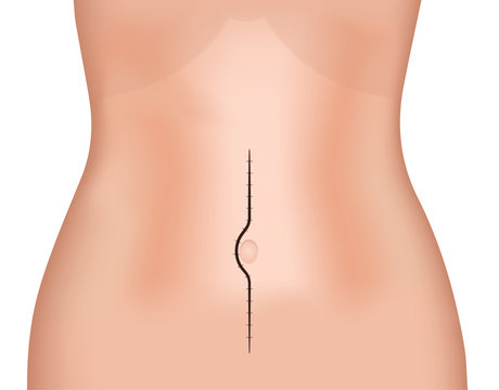 Midline Incision
