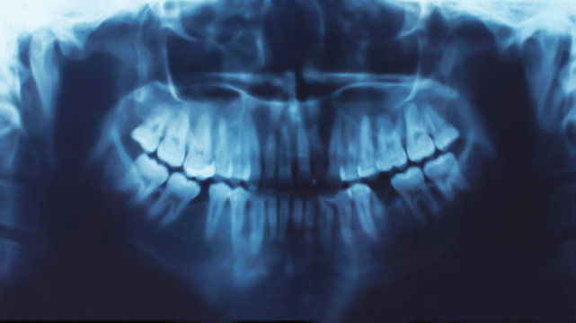 X-ray of teeth, stomatology concept