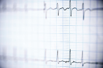 Electrocardiogram