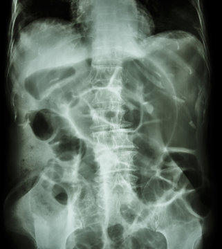 Bowel Obstruction ( X-ray abdomen supine position )
