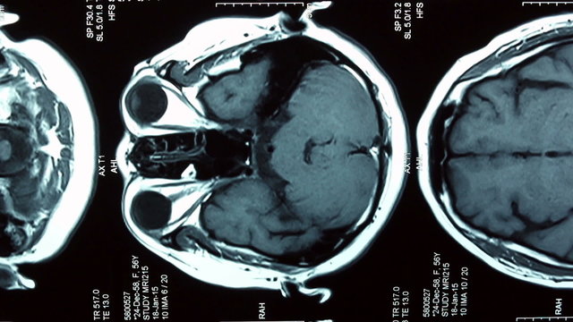 MRI brain scan, Dolly shot