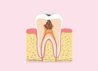 Decayed tooth anatomy in flat design version