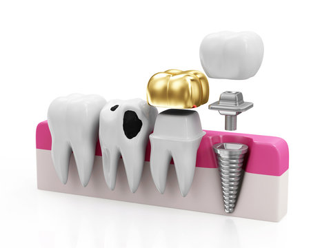 Health Tooth, Teeth with Caries, Dental Crown and Implant