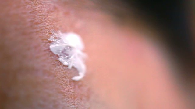 Slurring pimple cream for acne. Macro video close-up