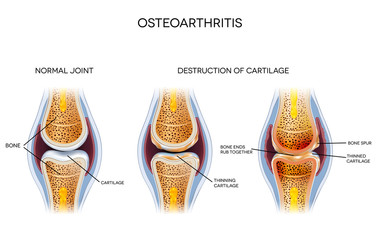 Osteoarthritis, destruction of cartilage - obrazy, fototapety, plakaty