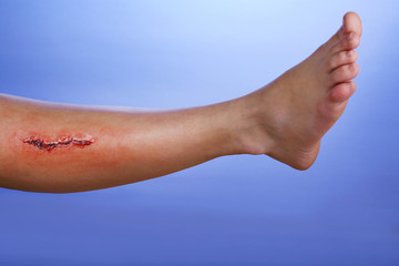 Injured leg with blood on blue background