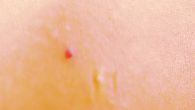 Close up of squeezing the infected pustulous acne to inoculation