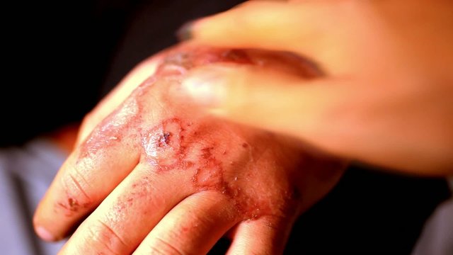 Close up of lubrication wound healing cream. Extreme macro video
