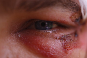 Close up of swollen eye after an accident with scars